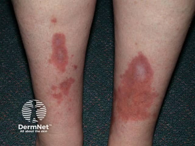 Gambar 2. Necrobiosis Lipoidica. Credits: Dermnet.